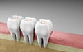 teeth inlays dental filling, Oral health and dental inspection teeth. Medical dentist tool, children healthcare, 3d render