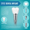 Teeth maquette. Structural elements of dental implant. Infographic for medicine poster