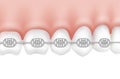 Teeth with metal braces