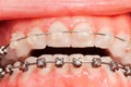 Teeth with metal and ceramic braces