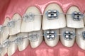 Teeth with metal and Clear braces. Medically accurate dental illustration