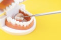 The Teeth model showing an implant dental demonstration teeth study teach model on yellow background