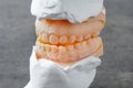 Teeth mold of an underbite malocclusion used for jaw surgery Royalty Free Stock Photo