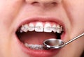 Teeth with orthodontic brackets. Royalty Free Stock Photo