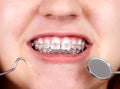 Teeth with orthodontic brackets. Royalty Free Stock Photo