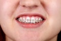 Teeth with orthodontic brackets. Royalty Free Stock Photo