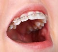 Teeth with orthodontic brackets. Royalty Free Stock Photo