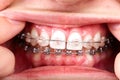 Teeth with orthodontic brackets.