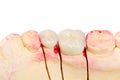 Teeth rehabilitation Royalty Free Stock Photo