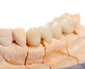 Teeth rehabilitation Royalty Free Stock Photo