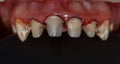 Teeth restored with the help of composite material and processed for prosthetics with crowns. Retraction of the gums.