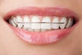 Teeth with retainer Royalty Free Stock Photo
