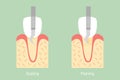 Teeth scaling - dental plaque removal, anatomy structure including the bone and gum