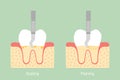 Teeth scaling - dental plaque removal, anatomy structure including the bone and gum