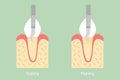 Teeth scaling - dental plaque removal, anatomy structure including the bone and gum