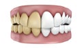 Teeth Set Isolated