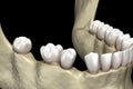 Teeth shift deformatiuon after losing teeth. 3D illustration of Popov Godon phenomenon
