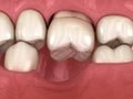 Teeth shift deformatiuon after losing molar tooth. 3D illustration of Popov Godon phenomenon