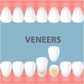 Teeth and smile makeover with dental ceramic veneers, row of foretooth before and after veneer cover Royalty Free Stock Photo