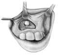 Teeth - Surgical Exposure of Impacted Incisor Royalty Free Stock Photo