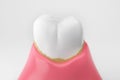 Teeth tartar or dental calculus