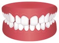 Teeth trouble bite type vector illustration /Excessive Spacing