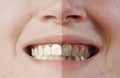 Teeth before and after