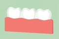 Teeth wear silicone trainer or invisible braces