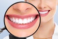 Teeth whitening Royalty Free Stock Photo