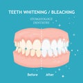 Teeth whitening and bleaching concept. Dentistry and stomatology vector Royalty Free Stock Photo