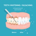 Teeth whitening and bleaching concept in flat style. Dentistry and stomatology vector Royalty Free Stock Photo