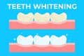 Teeth whitening or bleaching vector illustration. Concept of dental healthcare, stomatology care, professional tooth Royalty Free Stock Photo