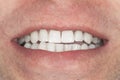 Teeth whitening close-up macro. Hygiene of the human oral cavity after admission to the dentist