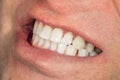 Teeth whitening close-up macro. Hygiene of the human oral cavity after admission to the dentist