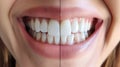 Before and After Teeth Whitening Comparison