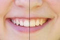 Teeth whitening before and after