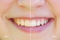 Teeth whitening before and after