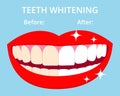 Teeth Whitening concept woth laughed mouse and teeth before and after bleaching. Vector isolated elemnts on blue Royalty Free Stock Photo