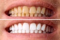 Teeth before and after whitening. Over white background. Dental clinic patient. Image symbolizes oral care dentistry Royalty Free Stock Photo