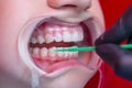 Teeth whitening procedure person whiten teeth in mouth expander