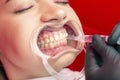 Teeth whitening procedure young girl dentist put bleach on teeth