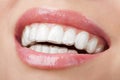 Teeth with whitening tray Royalty Free Stock Photo