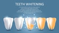 Teeth whitening vector medical poster banner template