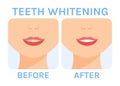 Teeth Whitening. Yellow Dirty Teeth. Treatment. Before and After. White Healthy Teeth and a Happy Smile on a Woman Face. Color Royalty Free Stock Photo