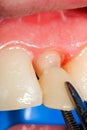 Temporary crown for tooth