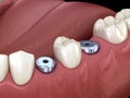 Temporary Implant abutments. Medically accurate 3D illustration of human teeth and dentures concept