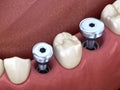 Temporary Implant abutments. Medically accurate 3D illustration of human teeth and dentures concept