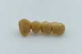 Temporary resin teeth. Provisional dental bridge. Dental implant concept