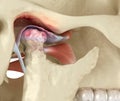 Temporomandibular joints arthritis and dislocated articular disc. Medically accurate 3D illustration