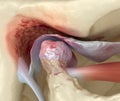 Temporomandibular joints arthritis and dislocated articular disc. Medically accurate 3D illustration